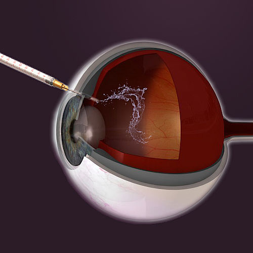 Intravitreale Injektion Paulig Eye And Health